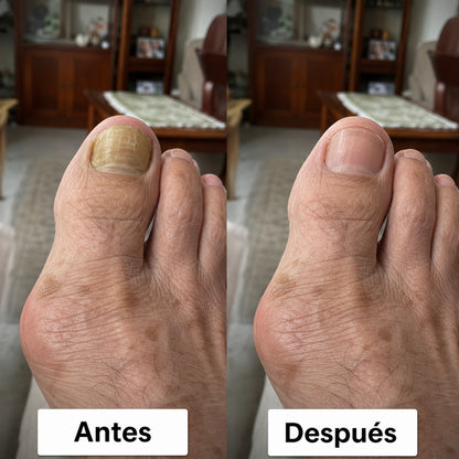 OnyCure v3™  · El primer tratamiento de luz ultravioleta que elimina los hongos desde la raíz. Resultado desde los primero 5 días (Hoy incluye GRATIS aceite natural que acelera el proceso).