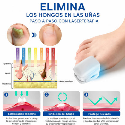 OnyCure v3™  · El primer tratamiento de luz ultravioleta que elimina los hongos desde la raíz. Resultado desde los primero 5 días (Hoy incluye GRATIS aceite natural que acelera el proceso).