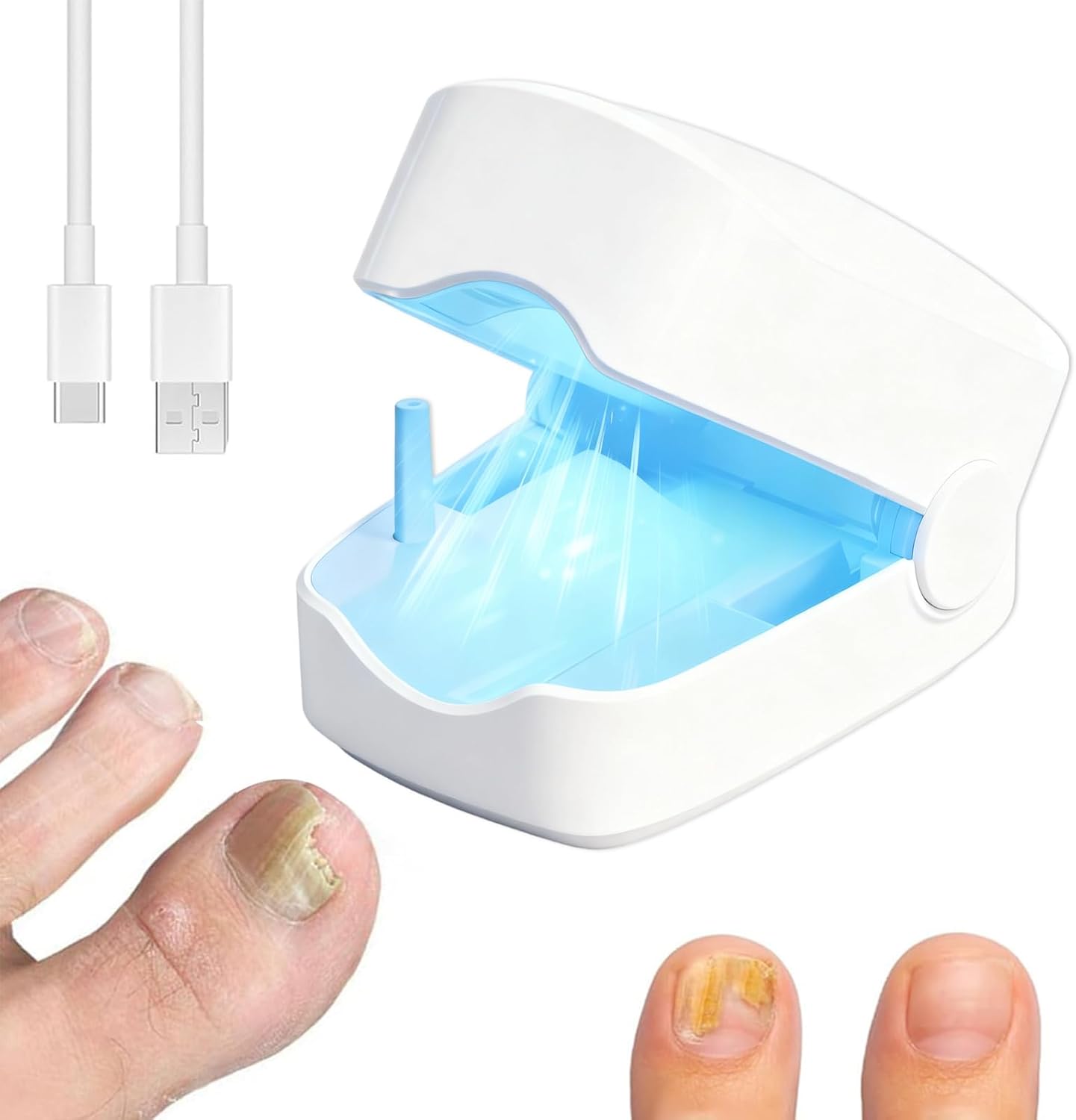 OnyCure - laser para hongos de unas