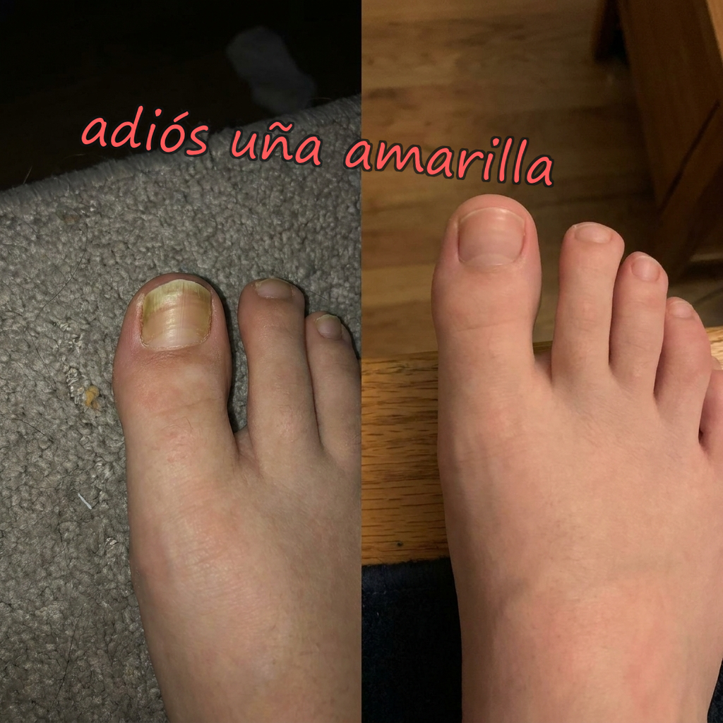 OnyClear™ con Tecnología Nanomérica – El único tratamiento intensivo de 7 días para la uña con hongo: deja de esconder los pies de tu pareja. (Hoy, regalo de bálsamo hidratante para pies y talones secos). *(Mejora visible o te devolvemos cada euro).