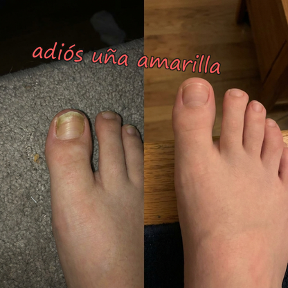 OnyClear™ con Tecnología Nanomérica – El único tratamiento intensivo de 7 días para la uña con hongo: deja de esconder los pies de tu pareja. (Hoy, regalo de bálsamo hidratante para pies y talones secos). *(Mejora visible o te devolvemos cada euro).