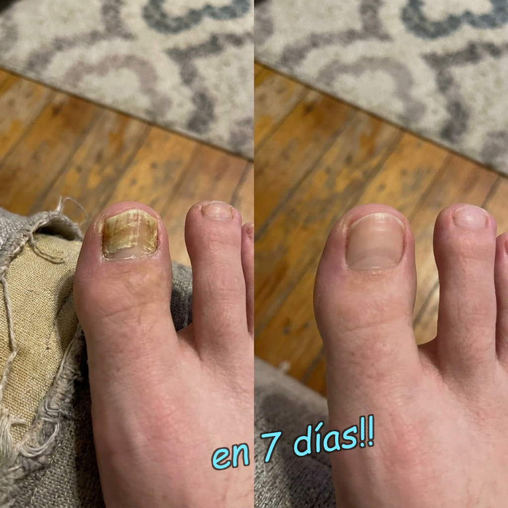 OnyClear™ con Tecnología Nanomérica – El único tratamiento intensivo de 7 días para la uña con hongo: deja de esconder los pies de tu pareja. (Hoy, regalo de bálsamo hidratante para pies y talones secos). *(Mejora visible o te devolvemos cada euro).