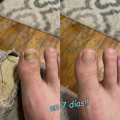 OnyClear™ con Tecnología Nanomérica – El único tratamiento intensivo de 7 días para la uña con hongo: deja de esconder los pies de tu pareja. (Hoy, regalo de bálsamo hidratante para pies y talones secos). *(Mejora visible o te devolvemos cada euro).