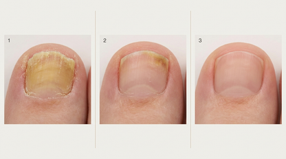 OnyClear™ con Tecnología Nanomérica – El único tratamiento intensivo de 7 días para la uña con hongo: deja de esconder los pies de tu pareja. (Hoy, regalo de bálsamo hidratante para pies y talones secos). *(Mejora visible o te devolvemos cada euro).